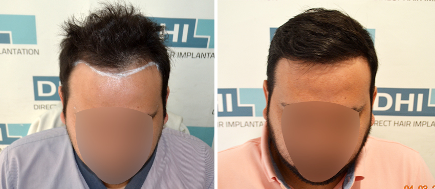 DHI before & after hair transplant results